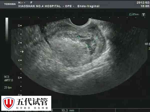 疤痕子宫怀双胞胎要减胎